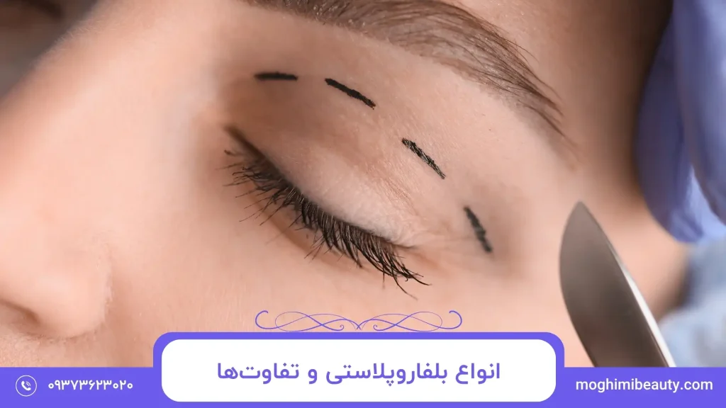 انواع بلفاروپلاستی و تفاوت‌ها