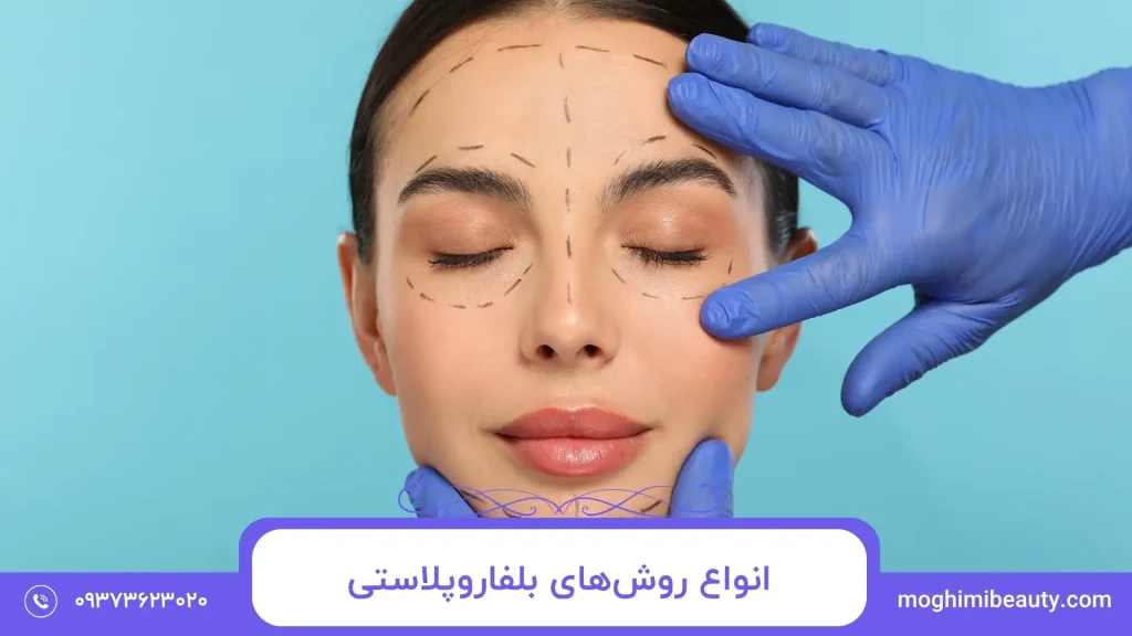 انواع روش‌های بلفاروپلاستی