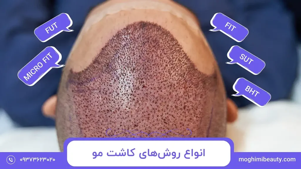 انواع روش‌های کاشت مو