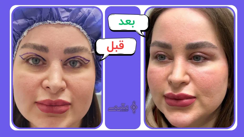 نمونه کارهای بلفاروپلاستی کلینیک مقیمی بیوتی
