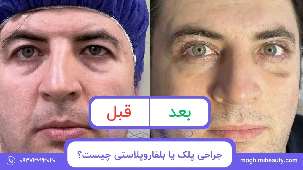 جراحی پلک یا بلفاروپلاستی چیست؟​