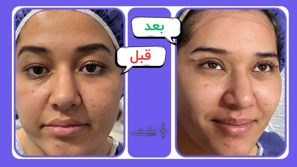 نمونه کارهای بلفاروپلاستی کلینیک مقیمی بیوتی