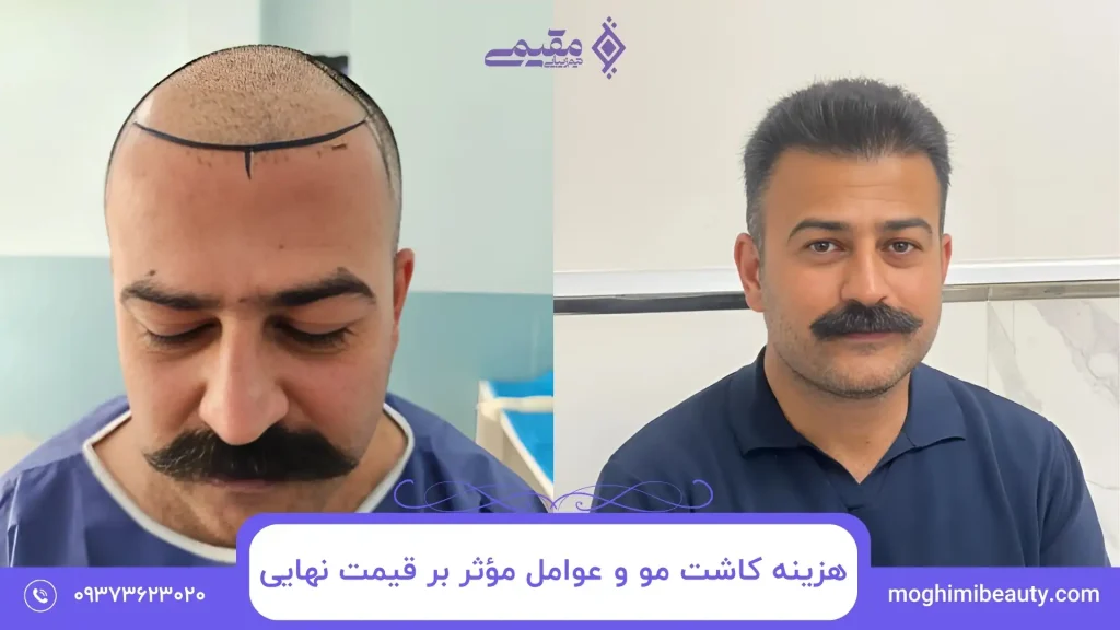 هزینه کاشت مو و عوامل مؤثر بر قیمت نهایی