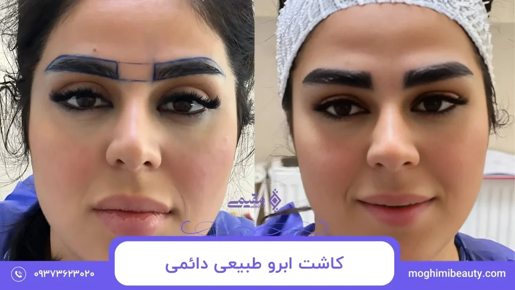 کاشت ابرو طبیعی دائمی