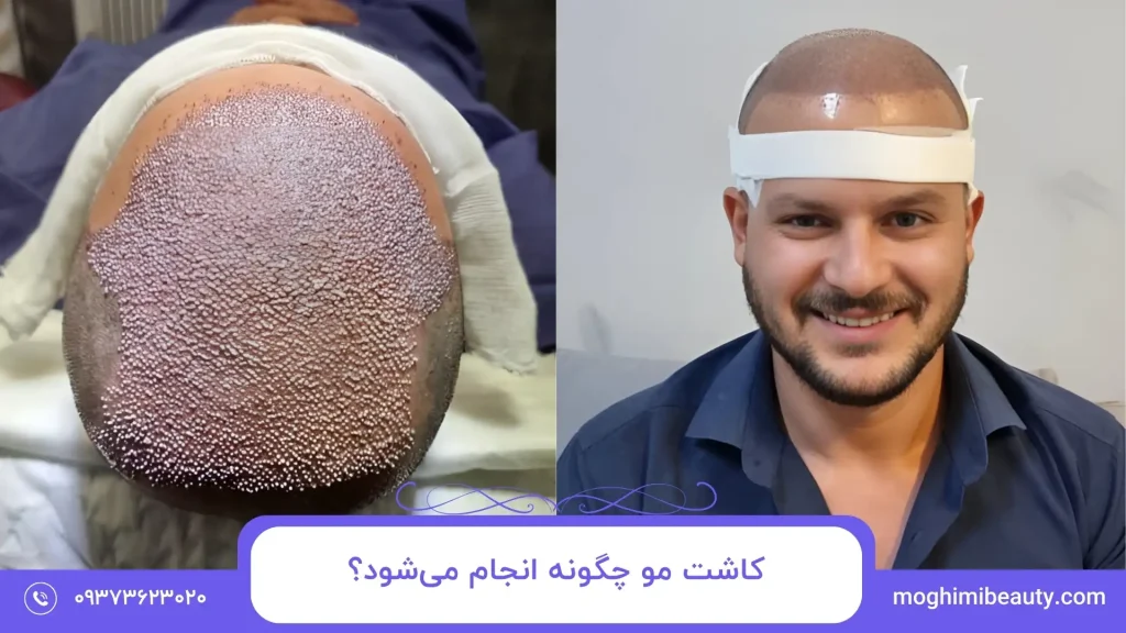 کاشت مو چگونه انجام می‌شود؟​