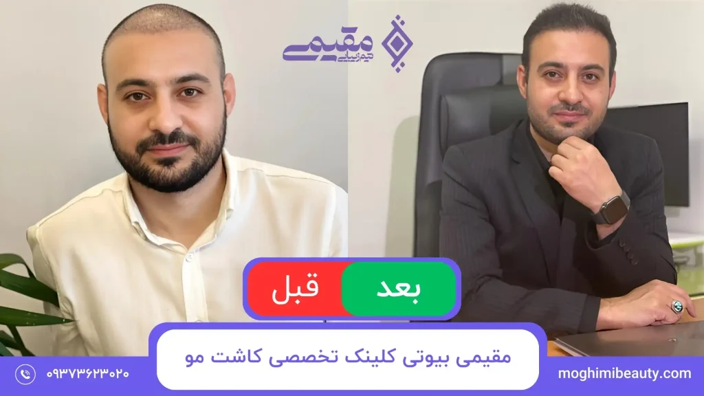 کاشت مو | کلینیک تخصصی کاشت مو در تهران⭐ مقیمی بیوتی