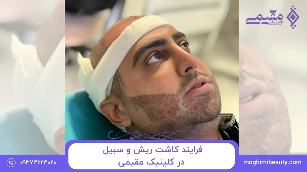 فرایند کاشت ریش و سبیل در کلینیک مقیمی بیوتی چگونه است؟