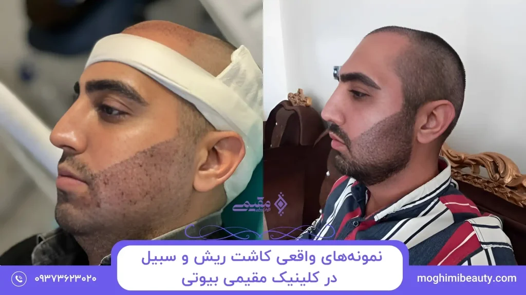 نمونه‌های واقعی کاشت ریش و سبیل در کلینیک مقیمی بیوتی