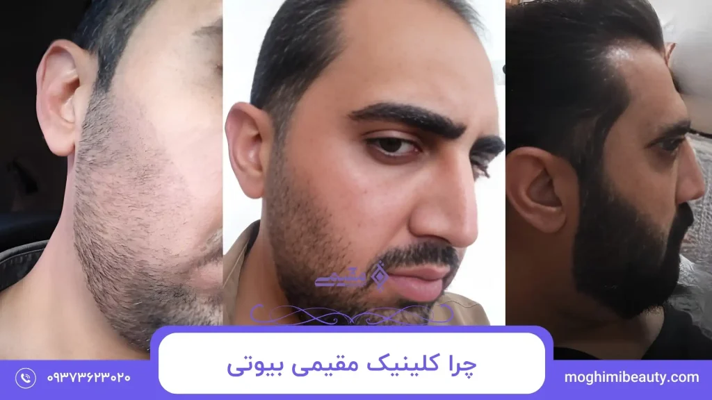 چرا کلینیک مقیمی بیوتی بهترین انتخاب برای کاشت ریش و سبیل در تهران است؟