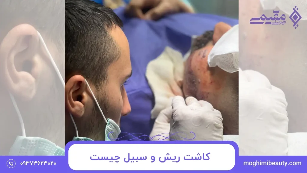 کاشت ریش و سبیل چیست و مناسب چه کسانی است؟