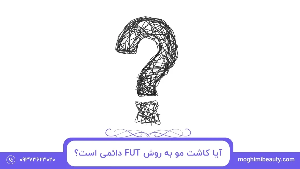 آیا کاشت مو به روش FUT دائمی است؟
