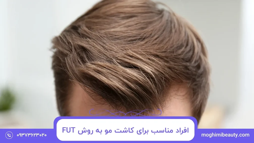 افراد مناسب برای کاشت مو به روش FUT