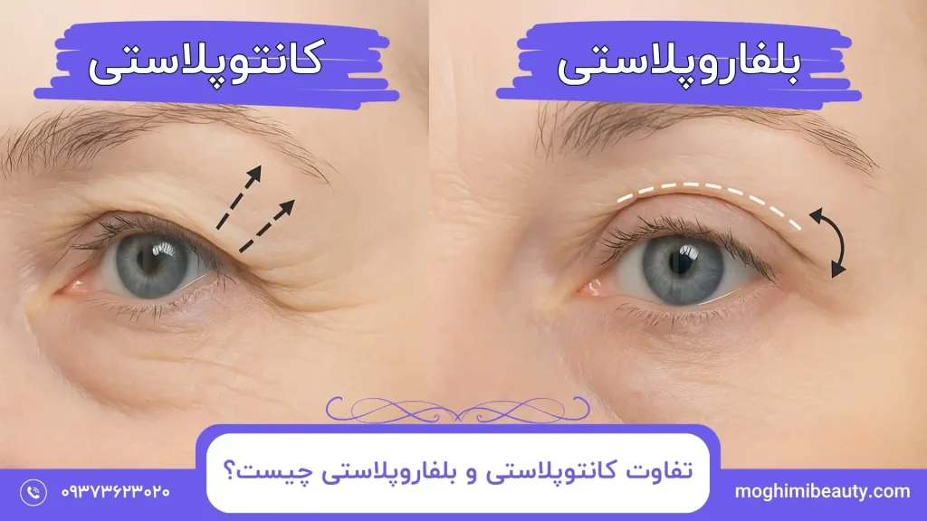 تفاوت کانتوپلاستی و بلفاروپلاستی چیست؟