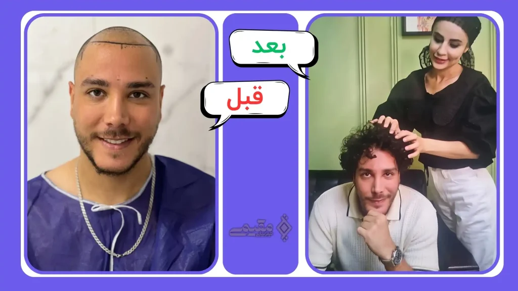 نمونه کار کاشت مو