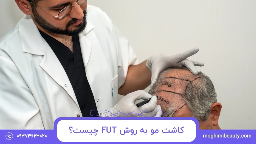 کاشت مو به روش FUT چیست؟