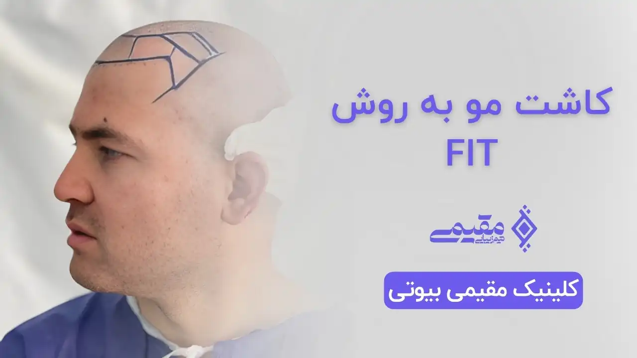 کاشت مو به روش FIT در تهران | بهترین روش کاشت مو در ایران⭐