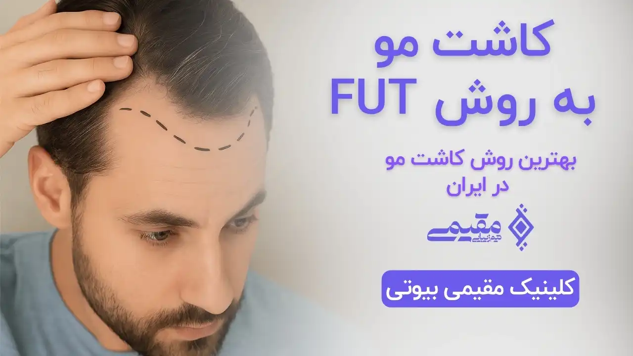 کاشت مو به روشFUT