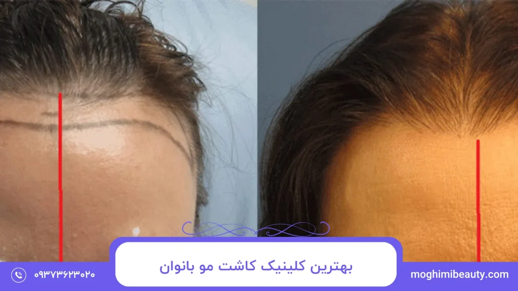 بهترین کلینیک کاشت مو بانوان