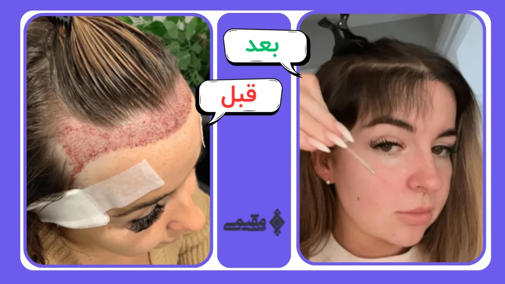 عکس کاشت مو زنان