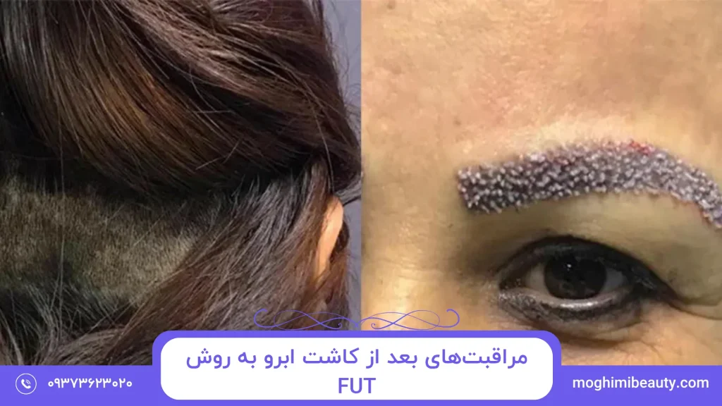مراقبت_های بعد از کاشت ابرو به روش FUT