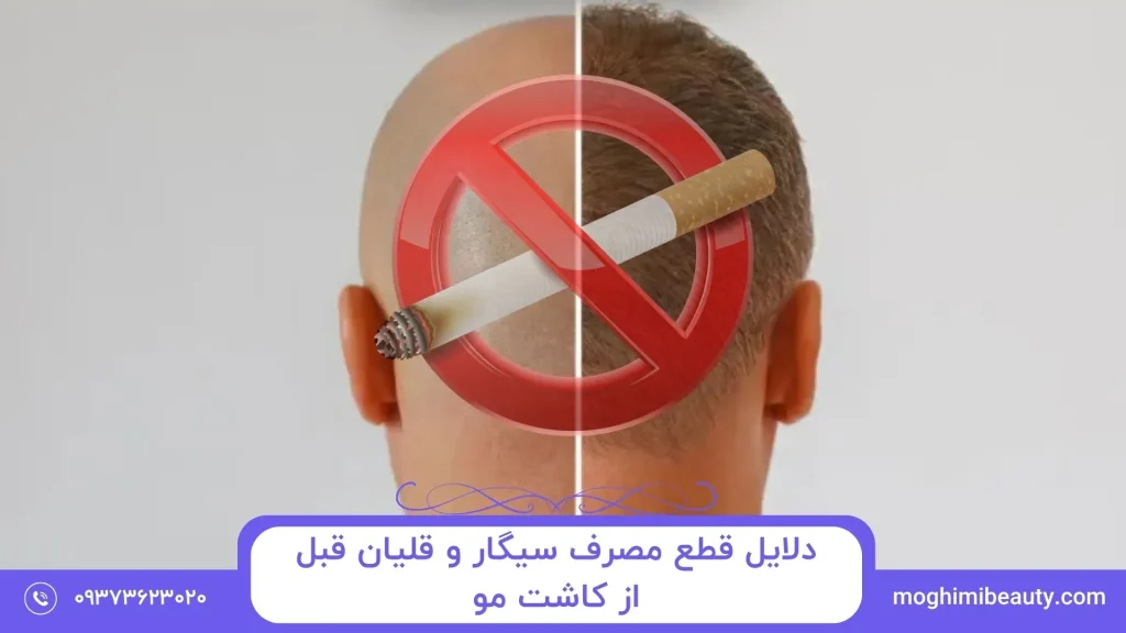 مصرف سیگار بعد از کاشت مو