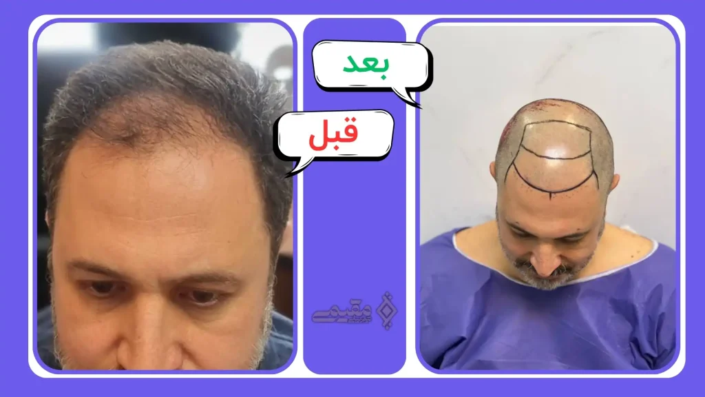 نمونه کاشت مو