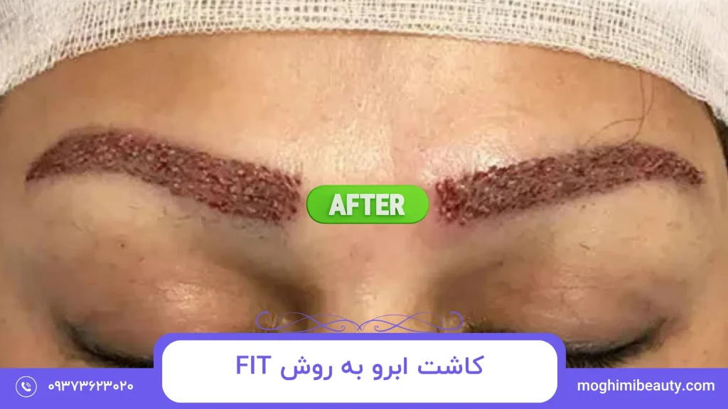 کاشت ابرو به روش FIT در تهران