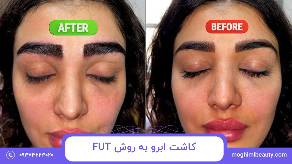 کاشت ابرو به روش FUT