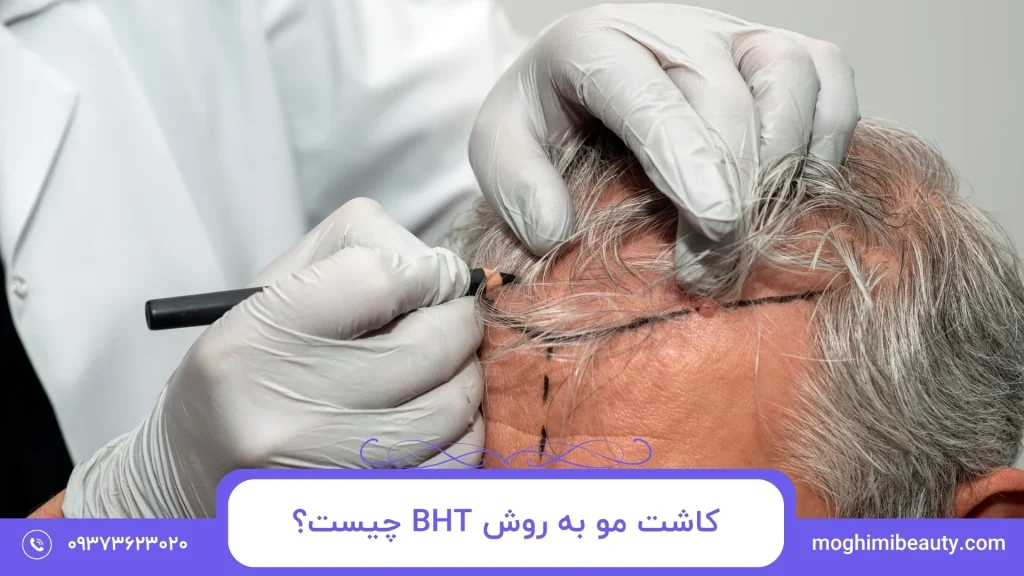 کاشت مو به روش BHT چیست؟