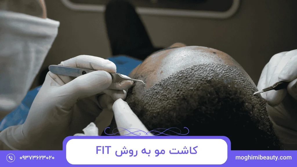 کاشت مو به روش FIT