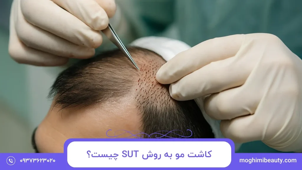 کاشت مو به روش SUT چیست؟