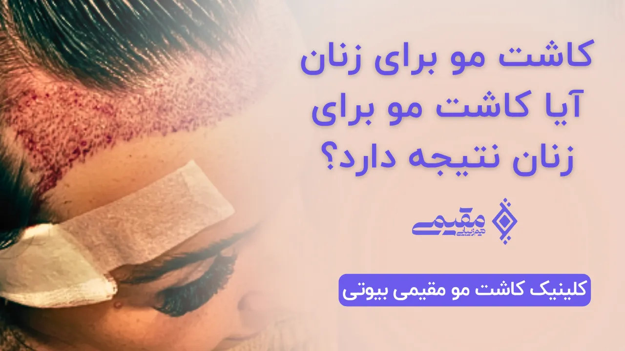 کاشت مو برای زنان