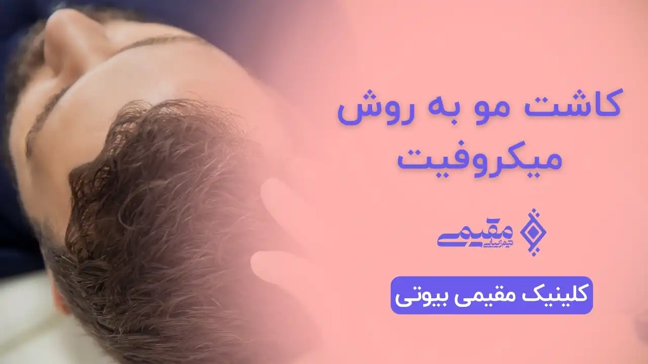 کاشت مو به روش میکروفیت