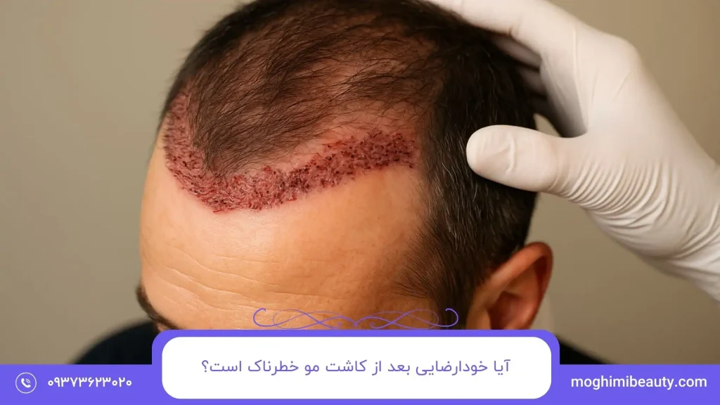 آیا خودارضایی بعد از کاشت مو خطرناک است؟