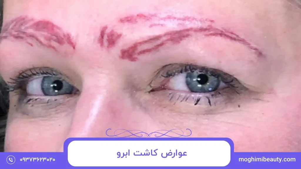 عوارض کاشت ابرو