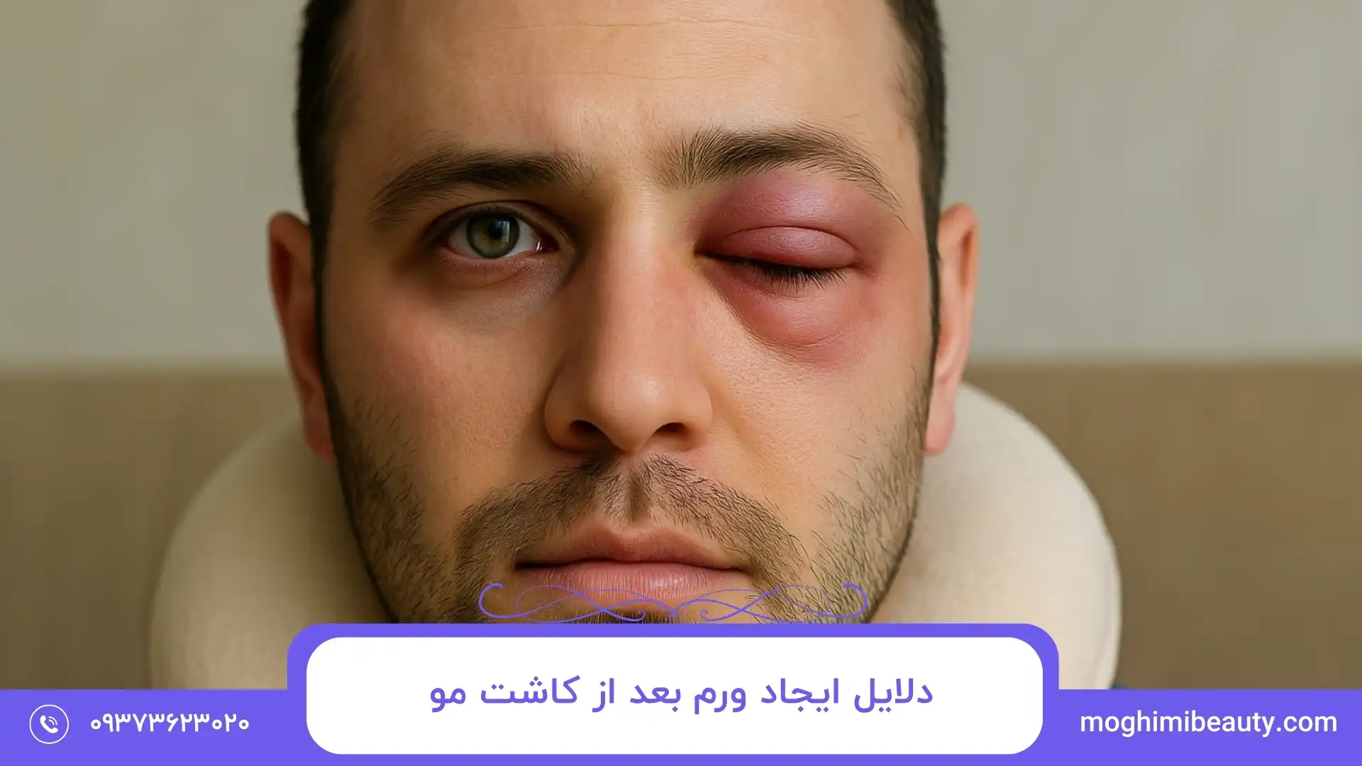 علت کبودی و ورم چشم بعد از کاشت مو چیست؟