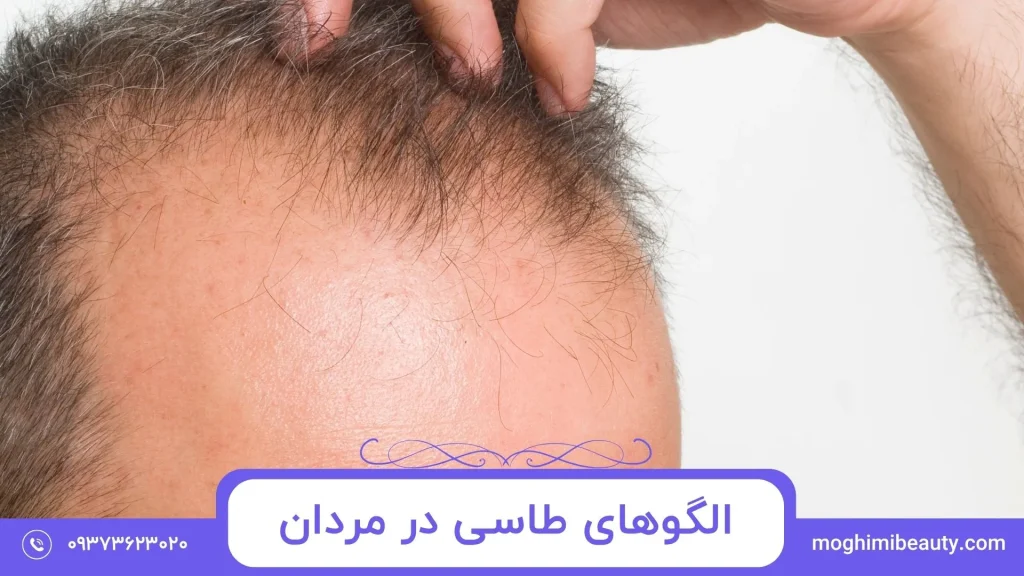 الگو های طاسی در مردان