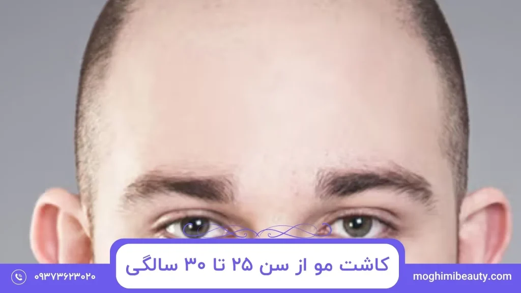 کاشت مو در سنین مختلف
