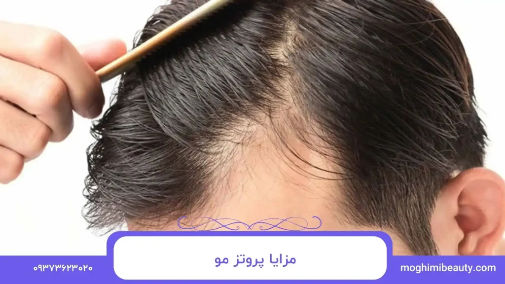 مزایا پروتز مو