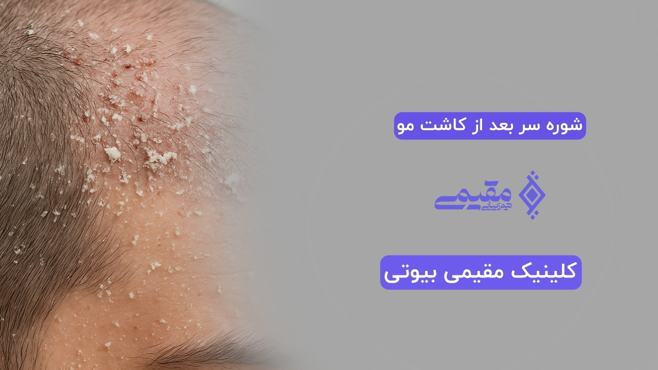 شوره سر بعد از کاشت مو؛ واکنش طبیعی پوست یا نشانه هشدار؟