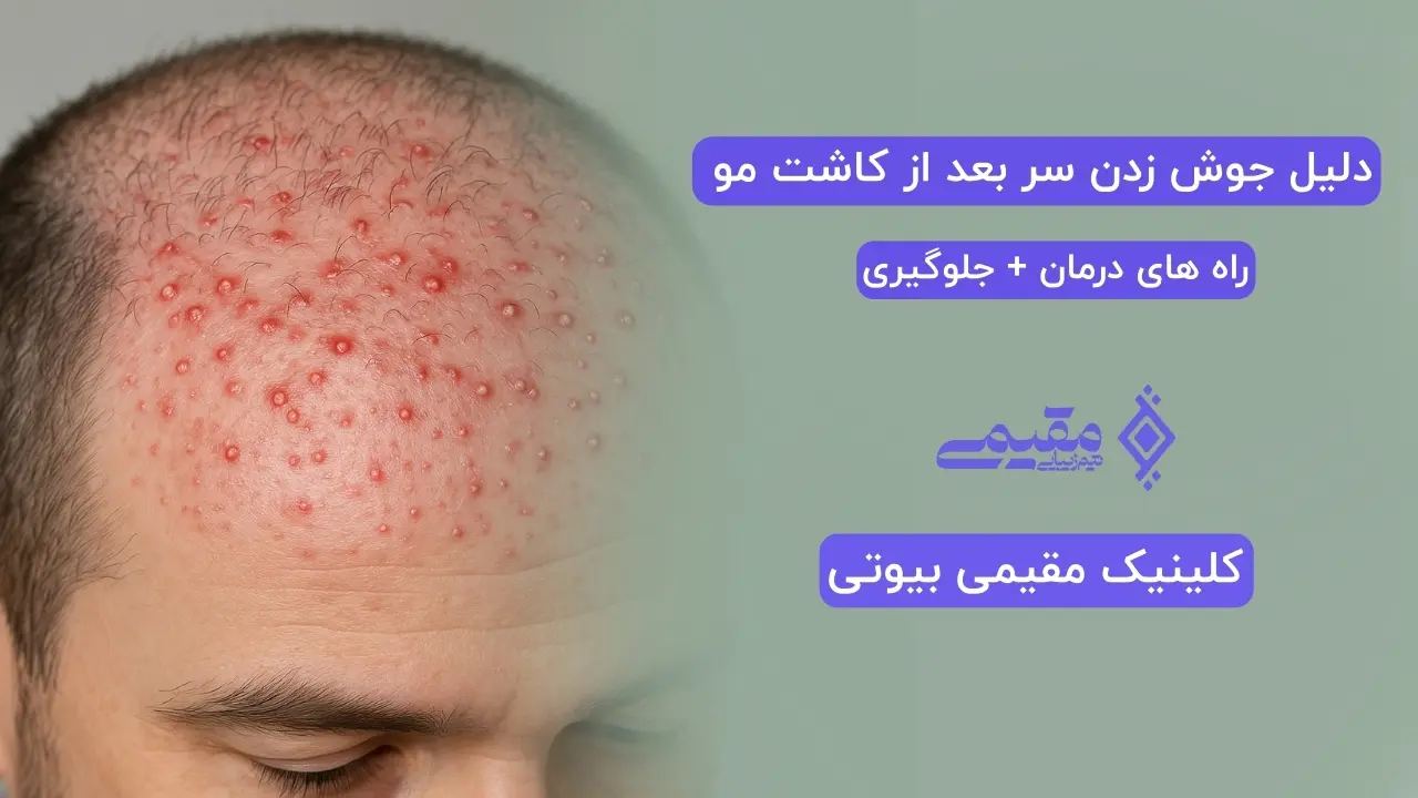 دلیل جوش زدن سر بعد از کاشت مو چیست؟ راه های درمان + جلوگیری