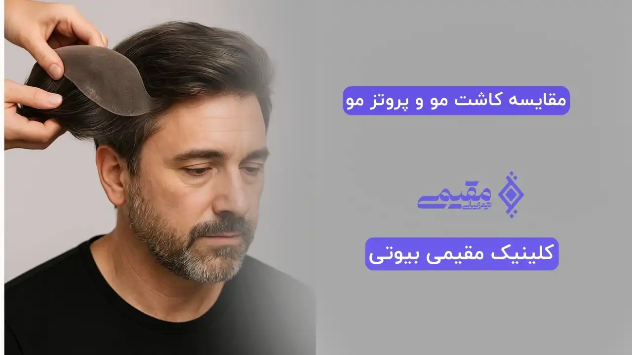 مقایسه کاشت مو و پروتز مو؛ کدام بهتر است؟