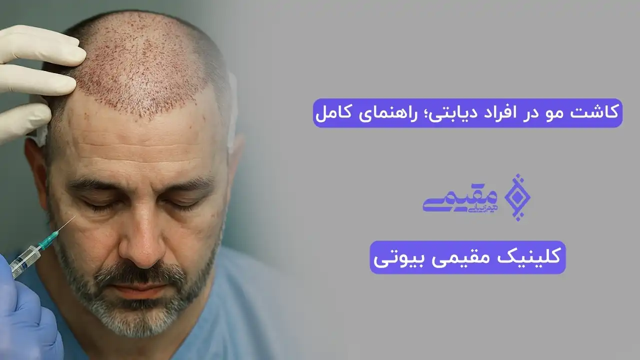 کاشت مو در افراد دیابتی؛ راهنمای کامل