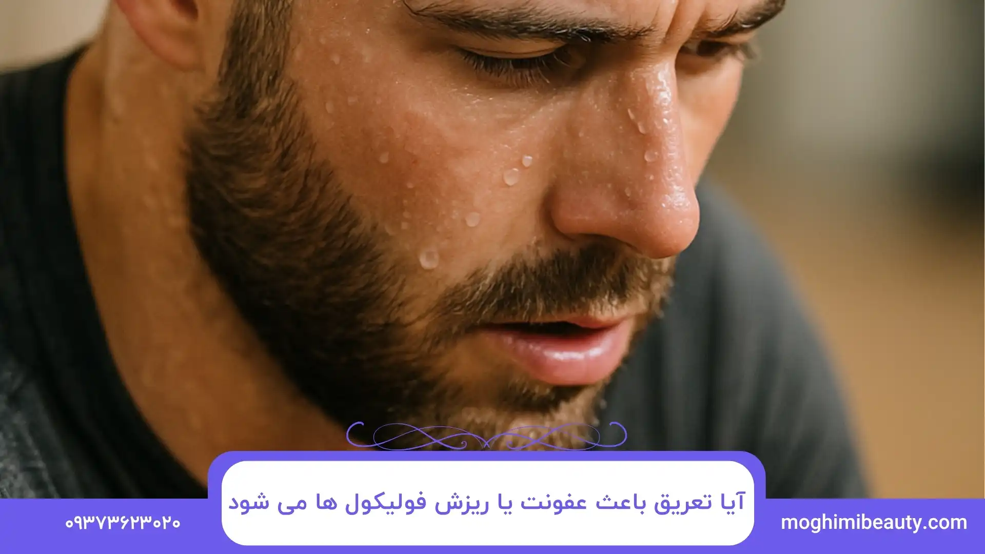 آیا تعریق باعث عفونت یا ریزش فولیکول ها می شود؟