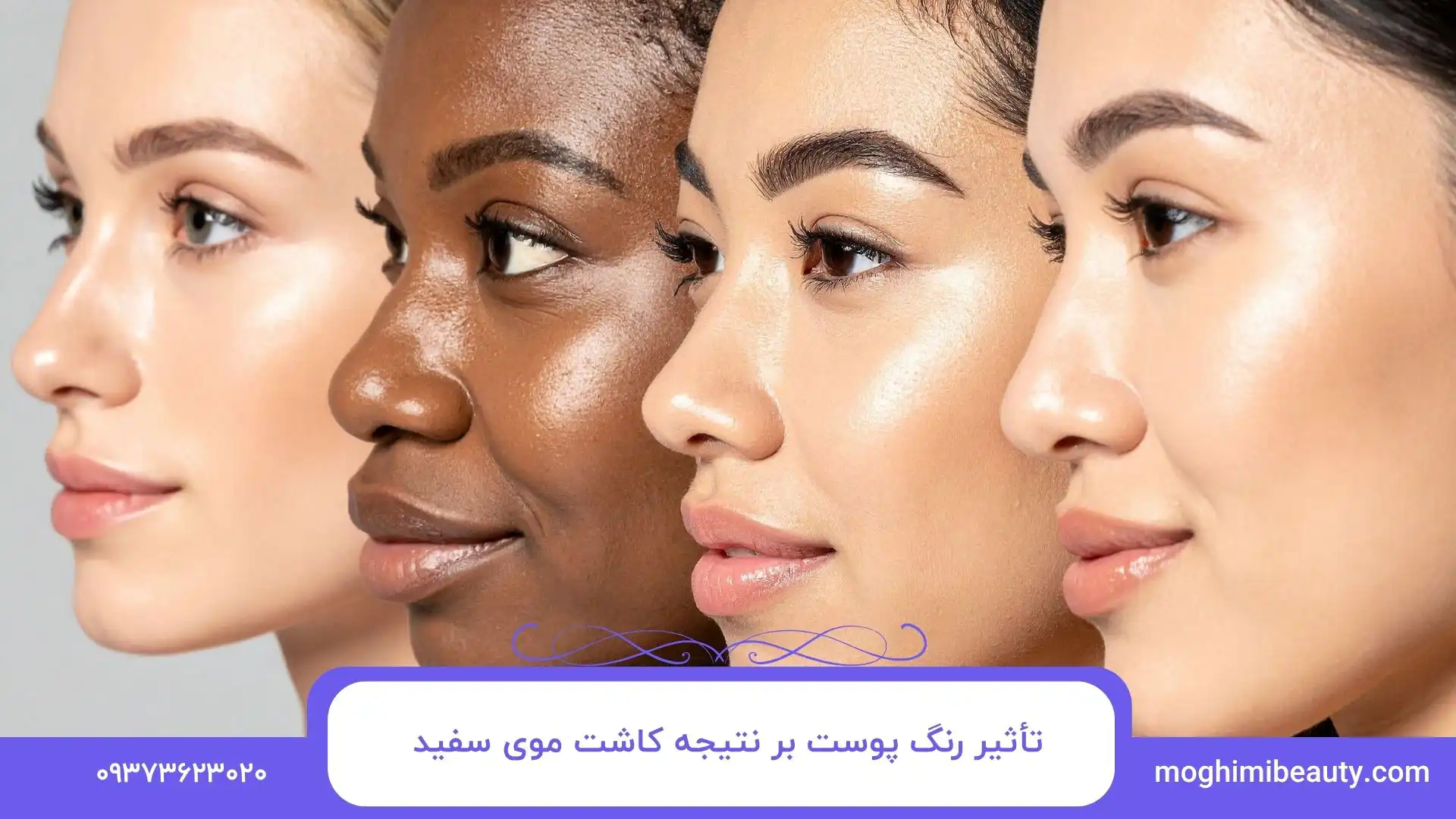 تأثیر رنگ پوست بر نتیجه کاشت موی سفید