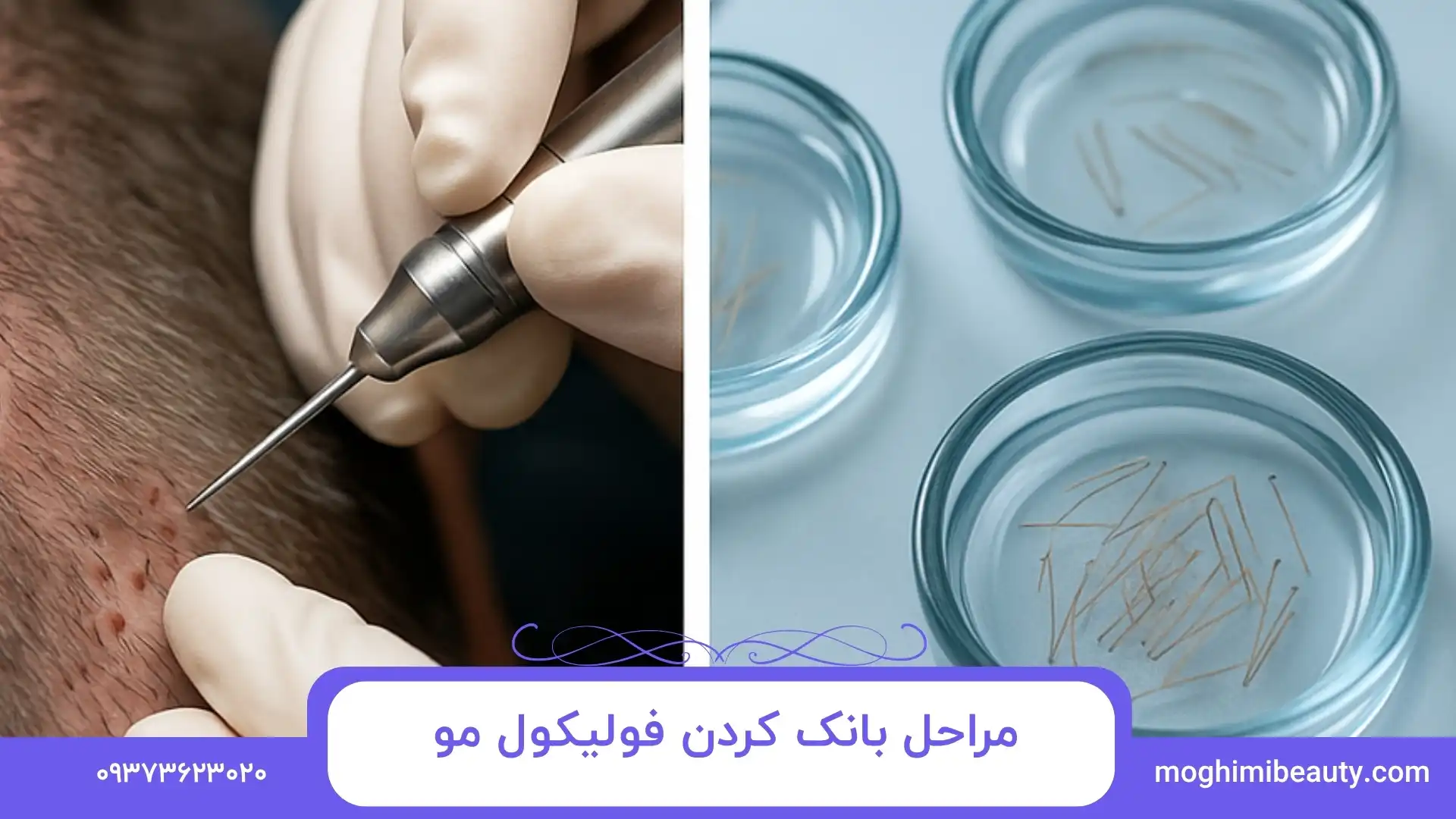 مراحل بانک‌ کردن فولیکول مو