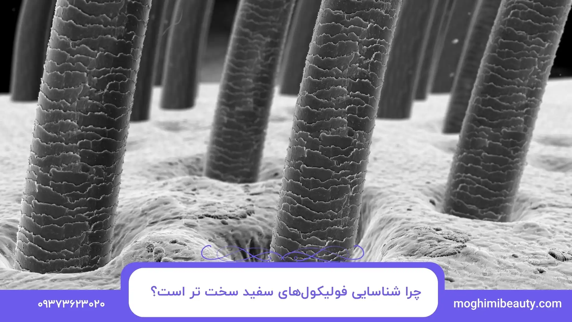 چرا شناسایی فولیکول‌های سفید سخت‌ تر است؟