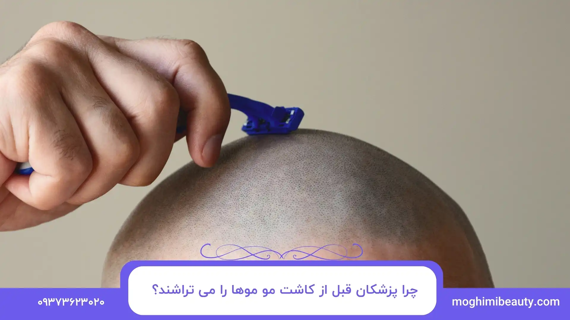 چرا پزشکان قبل از کاشت مو موها را می تراشند؟