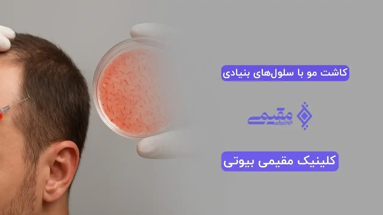 کاشت مو با سلول‌های بنیادی؛ روشی نوین برای درمان ریزش مو