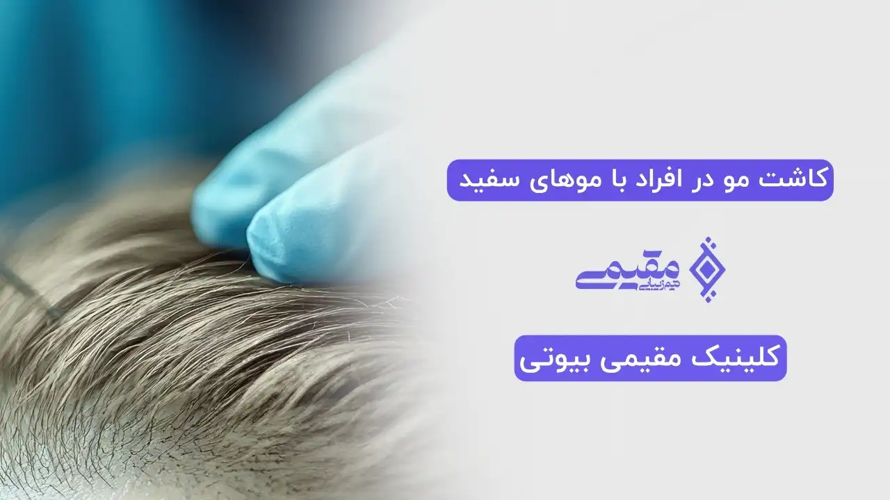 کاشت مو در افراد با موهای سفید